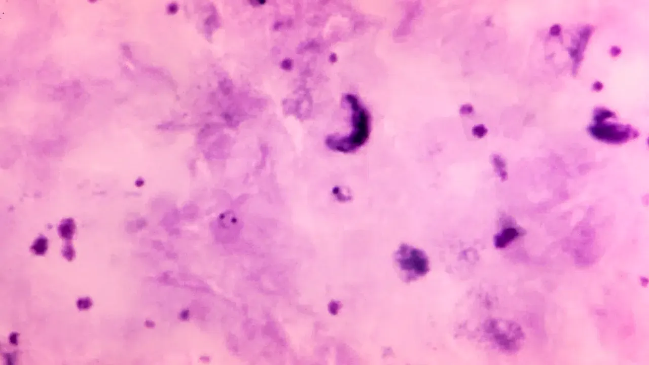 A 1125X photomicrograph magnification of Giemsa stained blood smear, revealed a number of Plasmodium falciparum parasites, in the form of gametocytes, and ring-