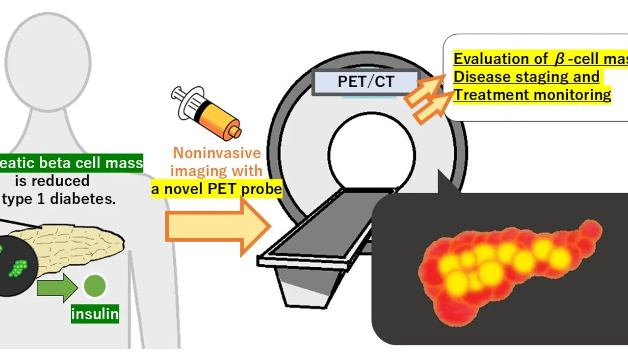 Image from medicalxpress.com: A New Way to See Beta Cell Loss Could Change How Doctors Track Type 1 Diabetes