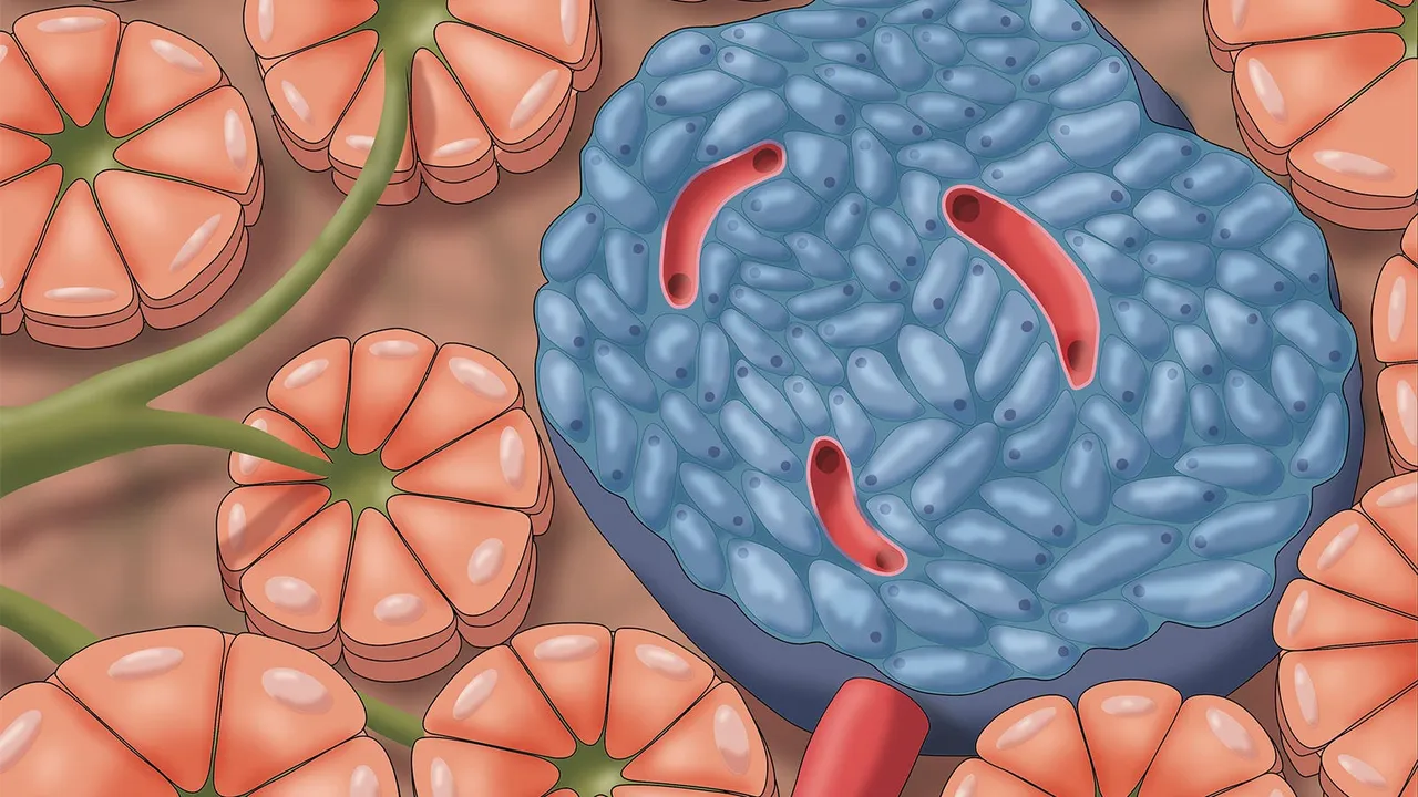 Image from medpagetoday.com: First Patient Receives Gene-Edited Islet Transplant Without Immunosuppression