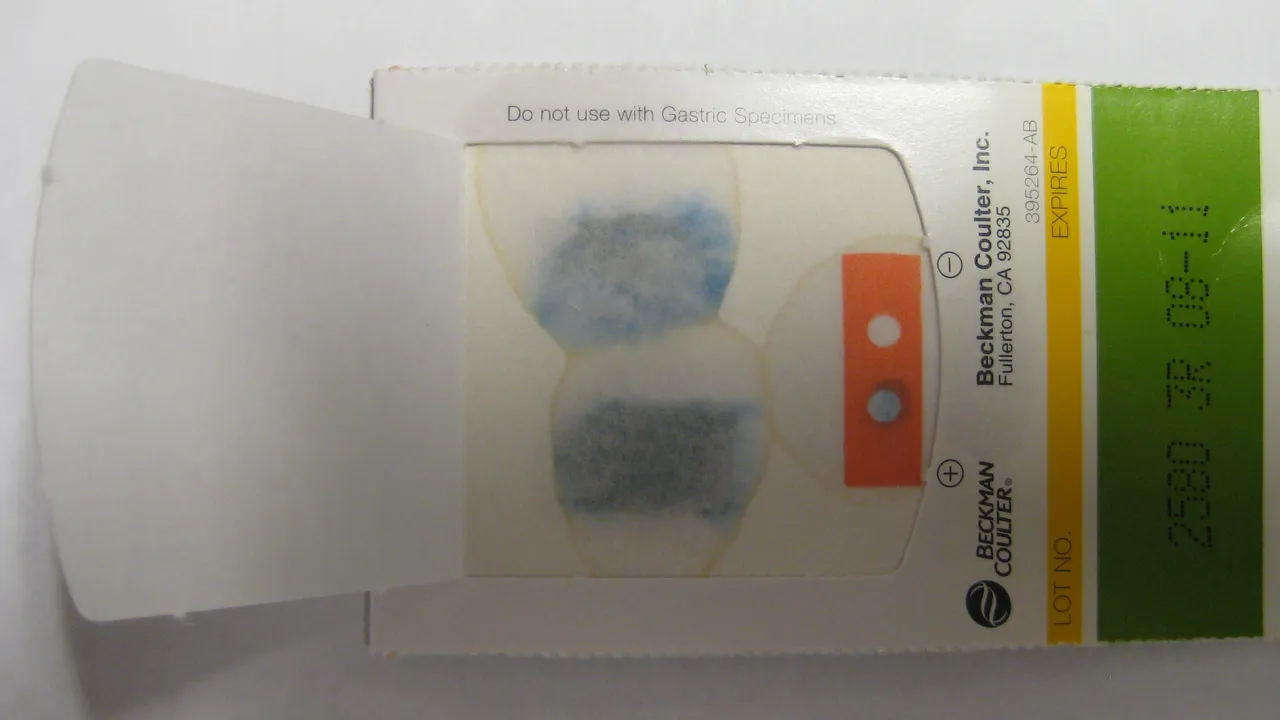 Positive fecal occult blood test