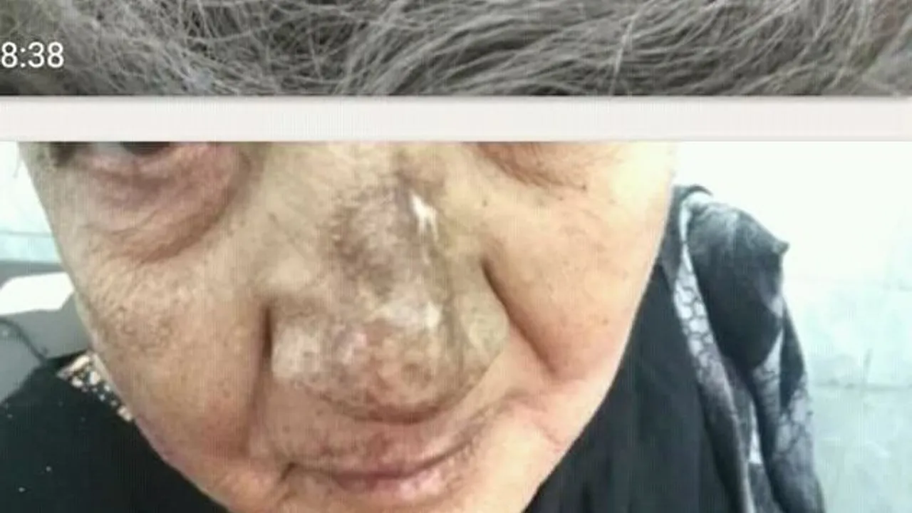 Discoid lupus erthymatouses new photo for help diagnosis avoid mistakes
