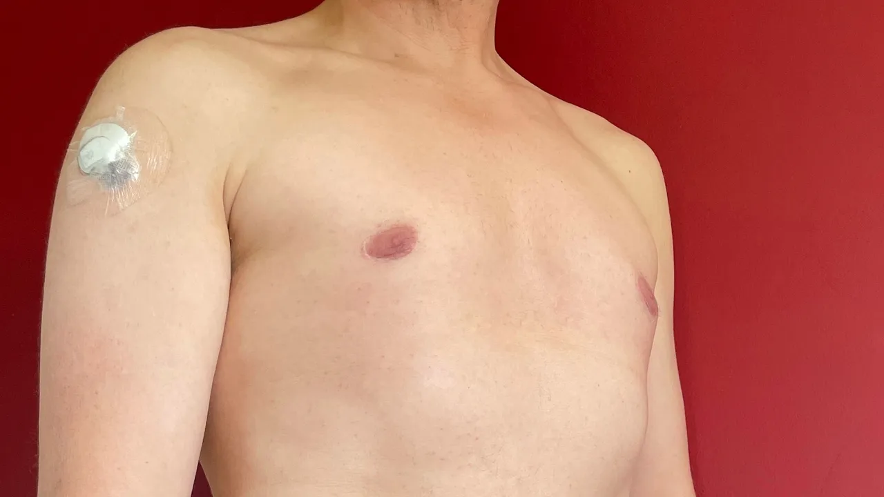 Diabetic Type 1 adult man with insulin pump and CGM sensor